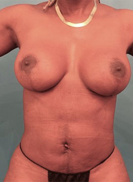 After Image: Breast Lift Patient #4 - 