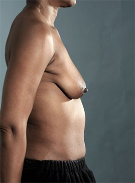 Before Image: Breast Lift Patient #4 -