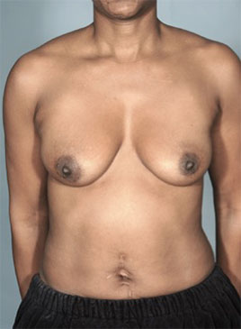 Before Image: Breast Lift Patient #4 - 
