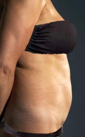 Before Image: Abdominoplasty/ Tummy Tuck Patient #2 -