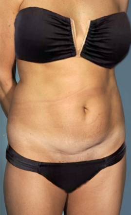 Before Image: Abdominoplasty/ Tummy Tuck Patient #2 -
