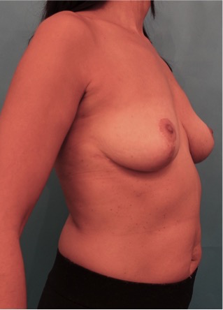 After Image: Breast Reduction Patient #2 -