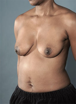 Before Image: Breast Lift Patient #4 -