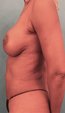 After Image: Breast Lift Patient #4 -