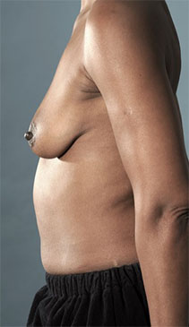 Before Image: Breast Lift Patient #4 -