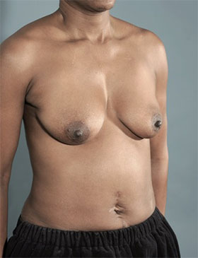 Before Image: Breast Lift Patient #4 -