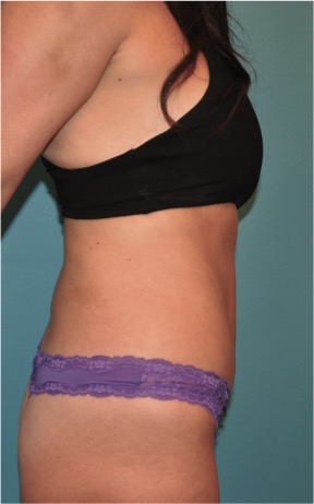After Image: Abdominoplasty/ Tummy Tuck Patient #2 -