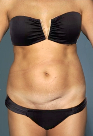 Before Image: Abdominoplasty/ Tummy Tuck Patient #2 -