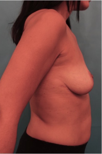 After Image: Breast Reduction Patient #2 -