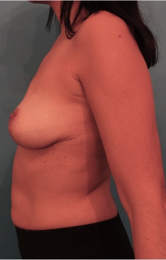 After Image: Breast Reduction Patient #2 -