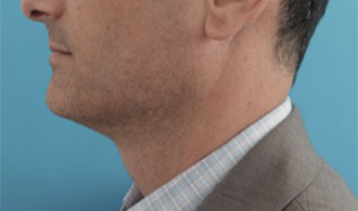 After Image: Male Kybella Patient #1 -