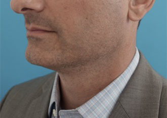 After Image: Male Kybella Patient #1 -