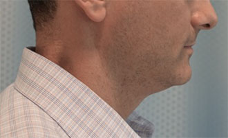Before Image: Male Kybella Patient #1 -