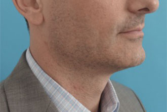 After Image: Male Kybella Patient #1 -