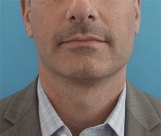 After Image: Male Kybella Patient #1 -