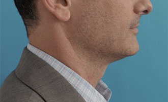After Image: Male Kybella Patient #1 -