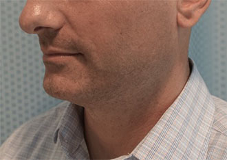 Before Image: Male Kybella Patient #1 -