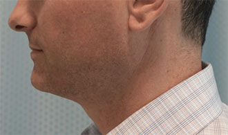 Before Image: Male Kybella Patient #1 -