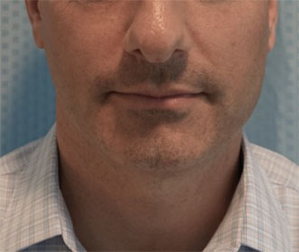 Before Image: Male Kybella Patient #1 -