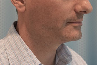 Before Image: Male Kybella Patient #1 -