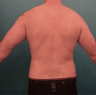 Liposuction Patient #8 After Photo # 2