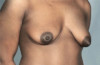 Breast Lift Patient #7 Before Photo Thumbnail # 3