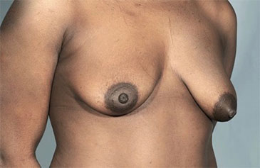 Breast Lift Patient #7 Before Photo # 3
