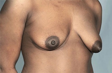 Before Image: Breast Lift Patient #7 -