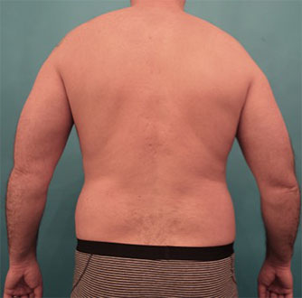 Liposuction Patient #8 Before Photo # 1