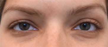Before Image: Dermal Fillers (Facial Contouring) Patient #3 -
