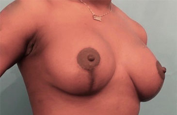 After Image: Breast Lift Patient #7 -