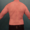 Male Liposuction Patient #7 After Photo Thumbnail # 2