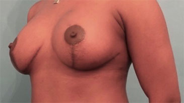 After Image: Breast Lift Patient #7 -