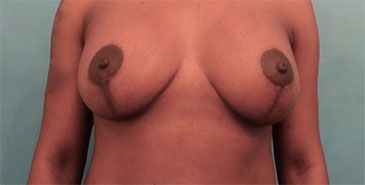 Breast Augmentation (Implants) Patient #11 After Photo # 2