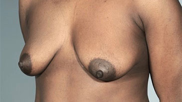 Before Image: Breast Lift Patient #7 -