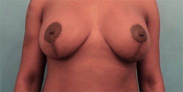 After Image: Breast Lift Patient #7 - 