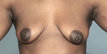 Breast Lift Patient #7 Before Photo # 1
