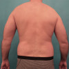 Male Liposuction Patient #7 Before Photo Thumbnail # 1