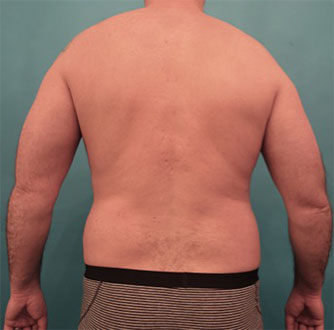 Male Liposuction Patient #7 Before Photo # 1
