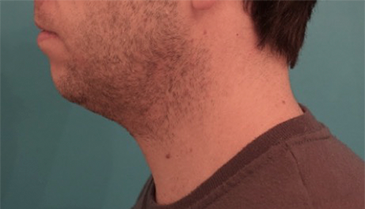 Before Image: Male Kybella Patient #2 - 