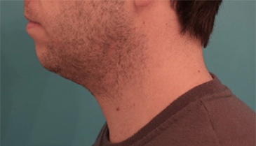 Male Kybella Patient #2 Before Photo # 5