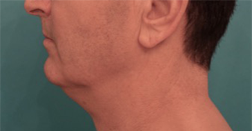 Male Kybella Patient #3 Before Photo # 1