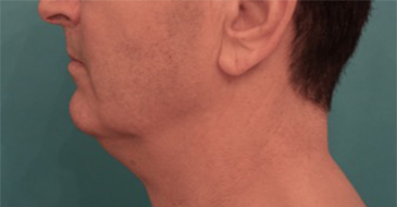 Before Image: Male Kybella Patient #3 - 