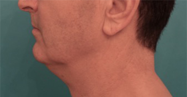 Male Kybella Patient