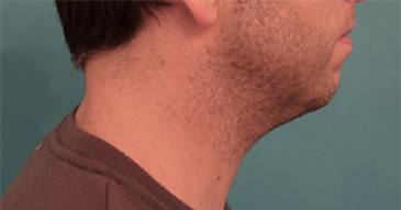 Before Image: Male Kybella Patient #2 - 