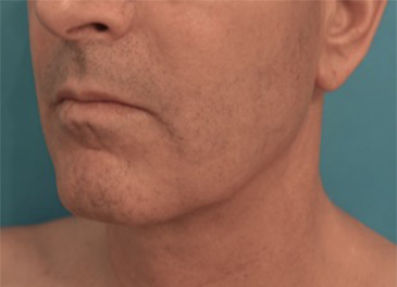 Kybella Patient #3 After Photo # 6