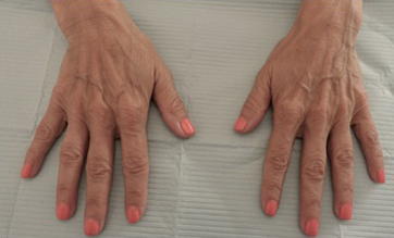 Dermal Fillers (Hand) Patient