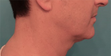 Before Image: Male Kybella Patient #3 -