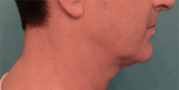 Male Kybella Patient #3 Before Photo # 3