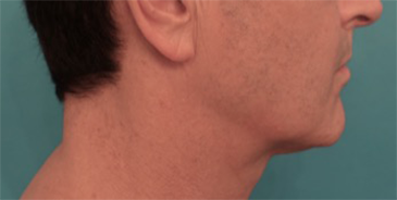 Kybella Patient #3 After Photo # 4